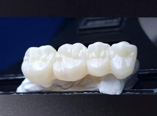 愛爾創全瓷冠美學款